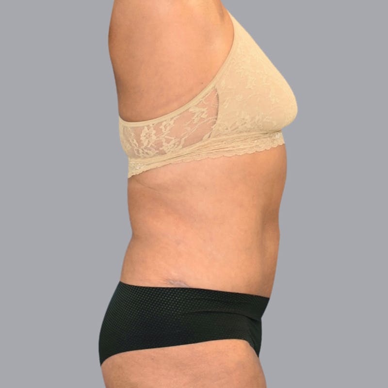 Abdominoplasty Before & After Gallery - Patient 48704249 - Image 4