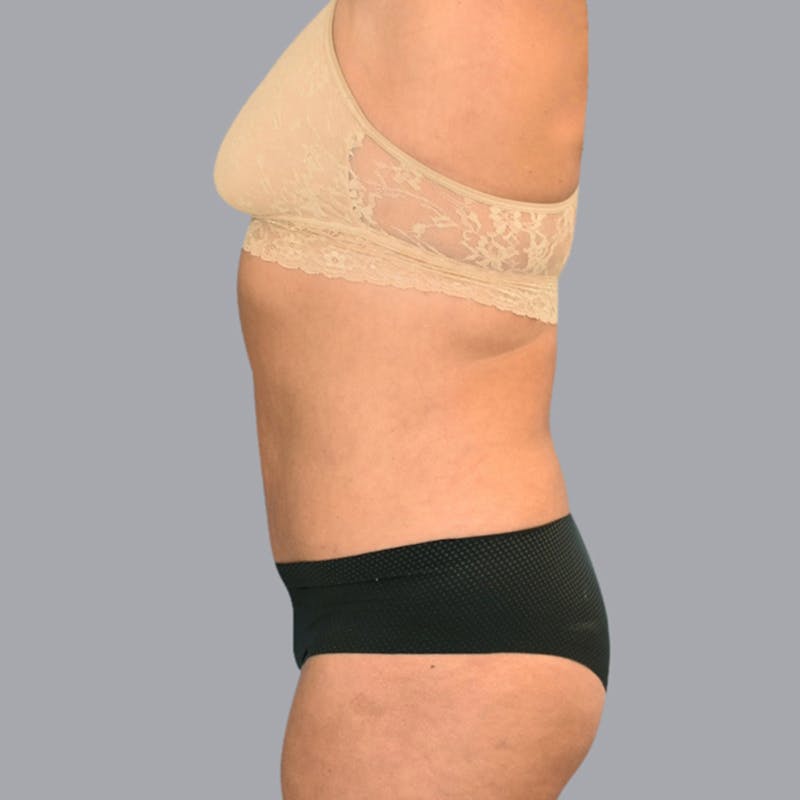 Abdominoplasty Before & After Gallery - Patient 48704249 - Image 6