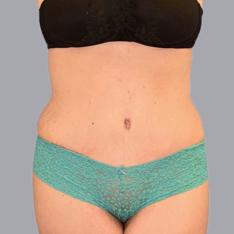 Abdominoplasty Before & After Gallery - Patient 48704254 - Image 2