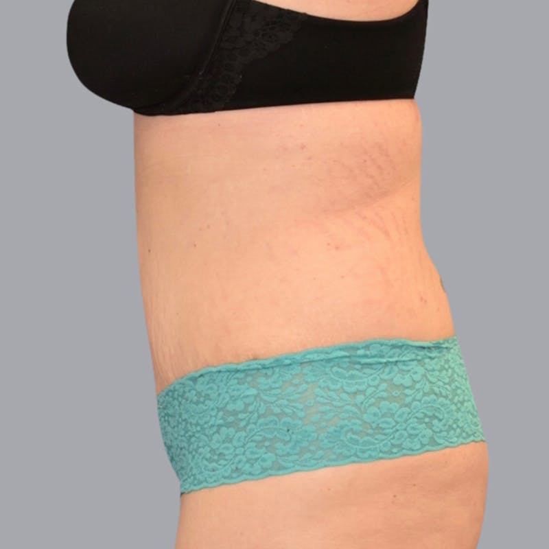 Abdominoplasty Before & After Gallery - Patient 48704254 - Image 4