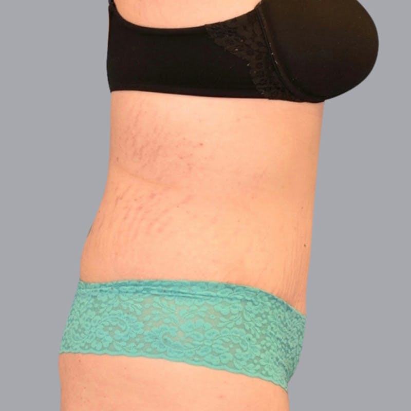 Abdominoplasty Before & After Gallery - Patient 48704254 - Image 6