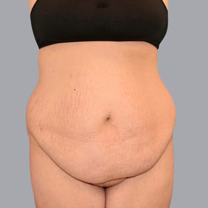 Abdominoplasty Before & After Gallery - Patient 48704254 - Image 1