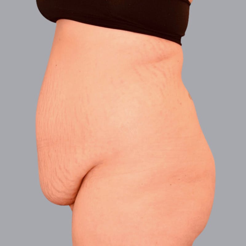 Abdominoplasty Before & After Gallery - Patient 48704254 - Image 3