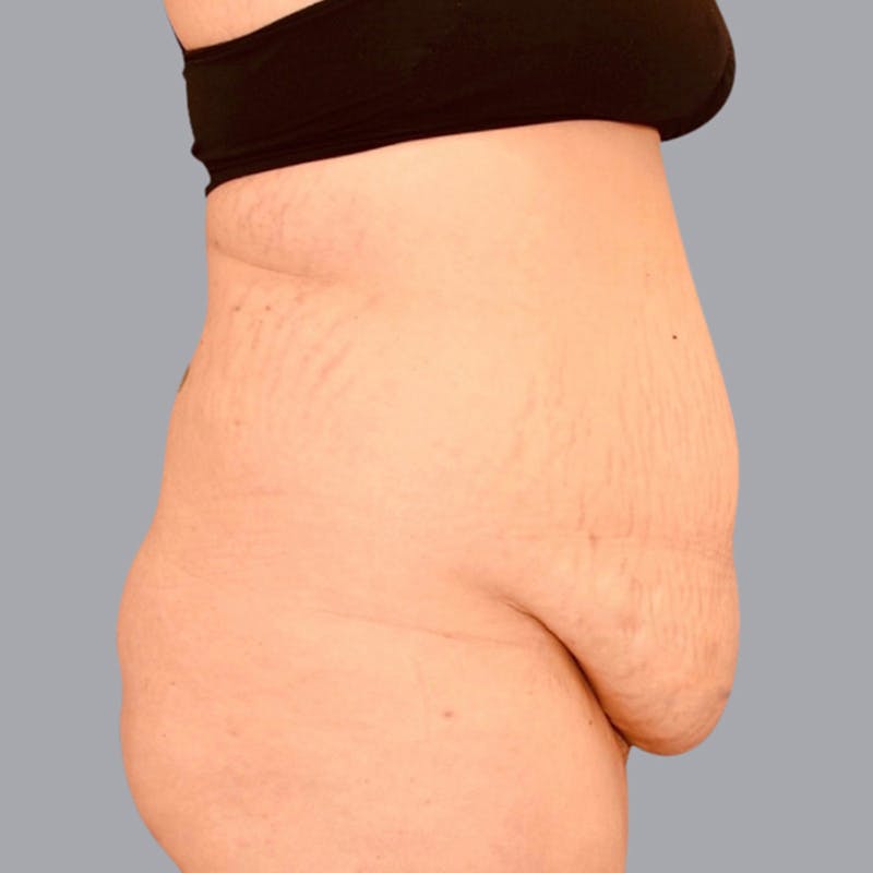 Abdominoplasty Before & After Gallery - Patient 48704254 - Image 5