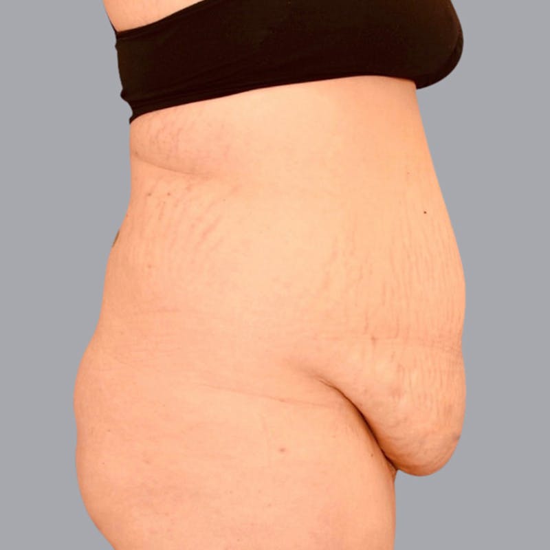 Abdominoplasty Before & After Gallery - Patient 48704254 - Image 5