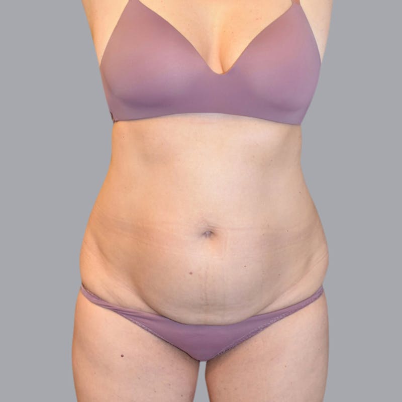 Abdominoplasty Before & After Gallery - Patient 48704255 - Image 1