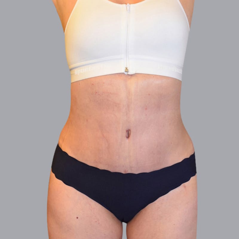Abdominoplasty Before & After Gallery - Patient 48704255 - Image 2