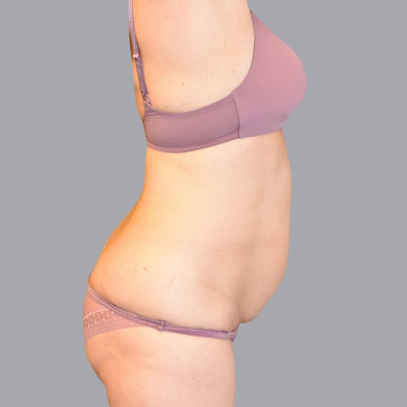 Abdominoplasty Before & After Gallery - Patient 48704255 - Image 3