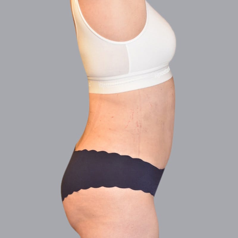 Abdominoplasty Before & After Gallery - Patient 48704255 - Image 4