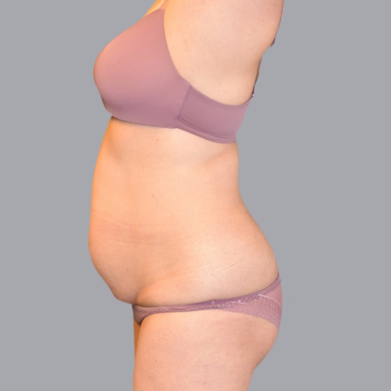 Abdominoplasty Before & After Gallery - Patient 48704255 - Image 5