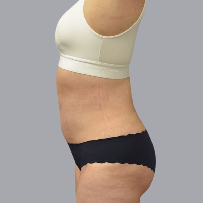 Abdominoplasty Before & After Gallery - Patient 48704255 - Image 6