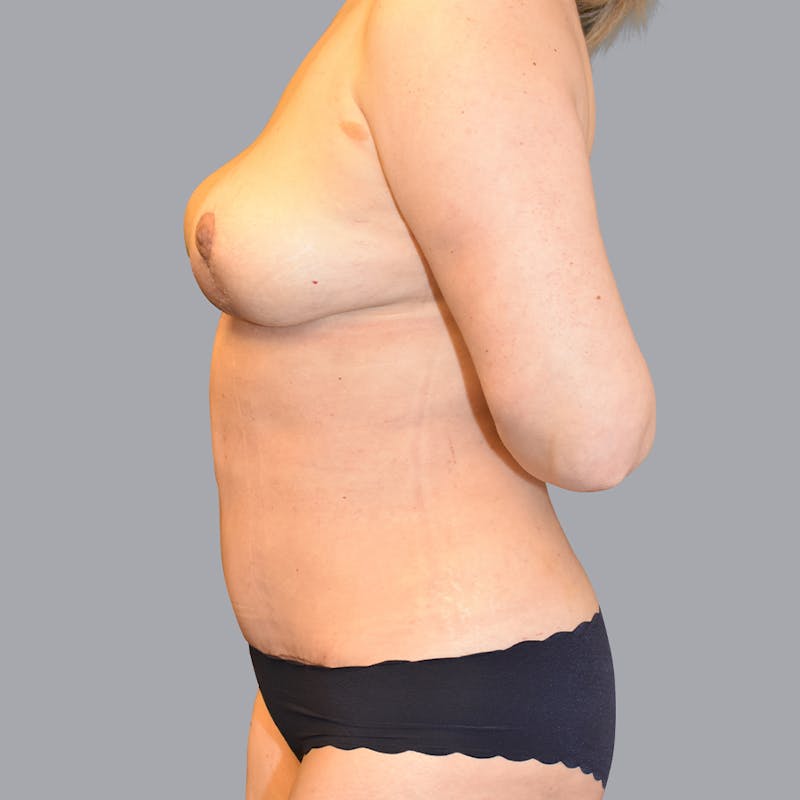 Mommy Makeover Before & After Gallery - Patient 48697862 - Image 6