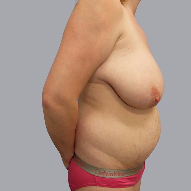 Mommy Makeover Before & After Gallery - Patient 55333278 - Image 1