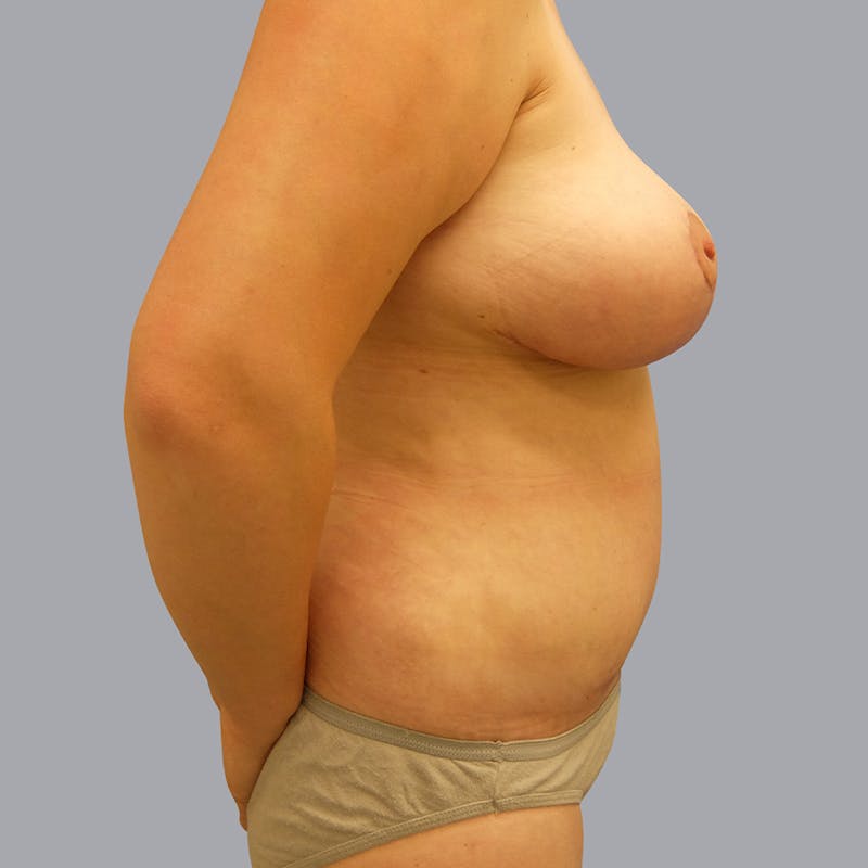 Mommy Makeover Before & After Gallery - Patient 55333278 - Image 2