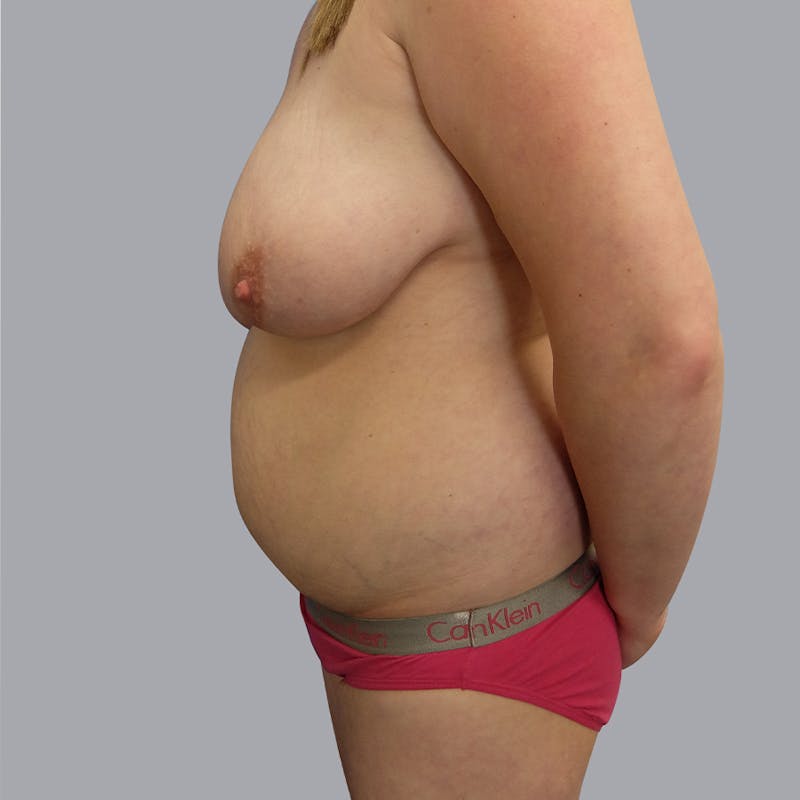 Mommy Makeover Before & After Gallery - Patient 55333278 - Image 3