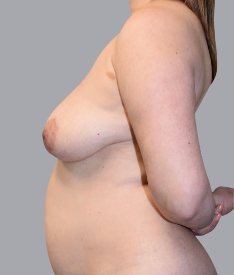 Breast Lift Before & After Gallery - Patient 55375364 - Image 5