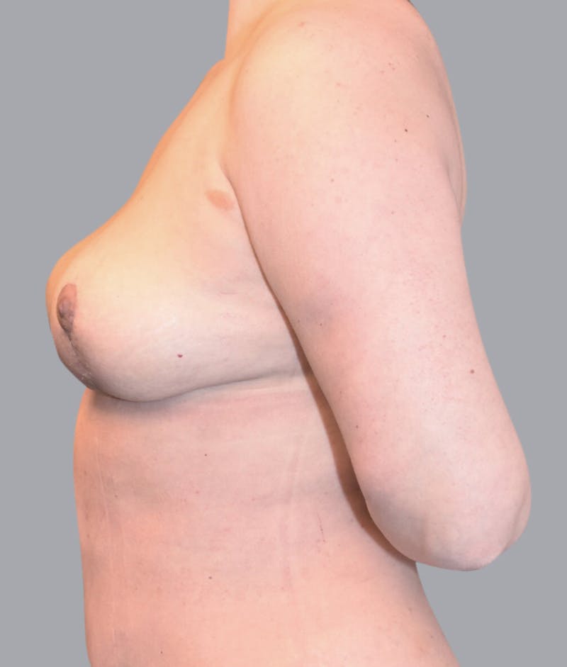 Breast Lift Before & After Gallery - Patient 55375364 - Image 6