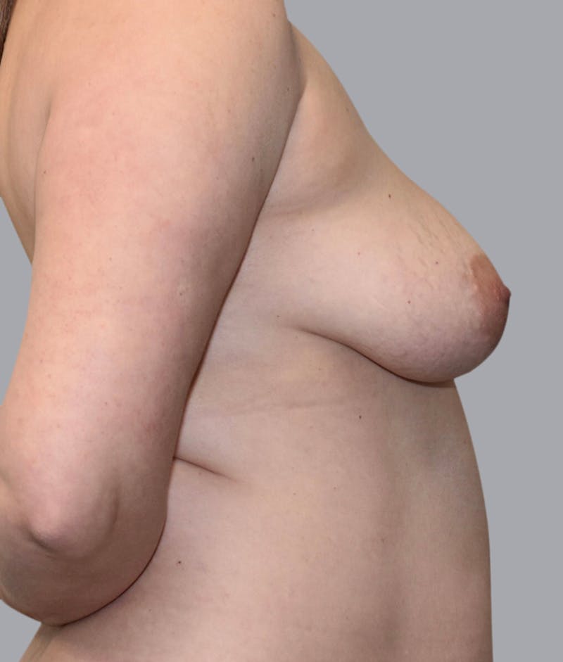 Breast Lift Before & After Gallery - Patient 55375364 - Image 3