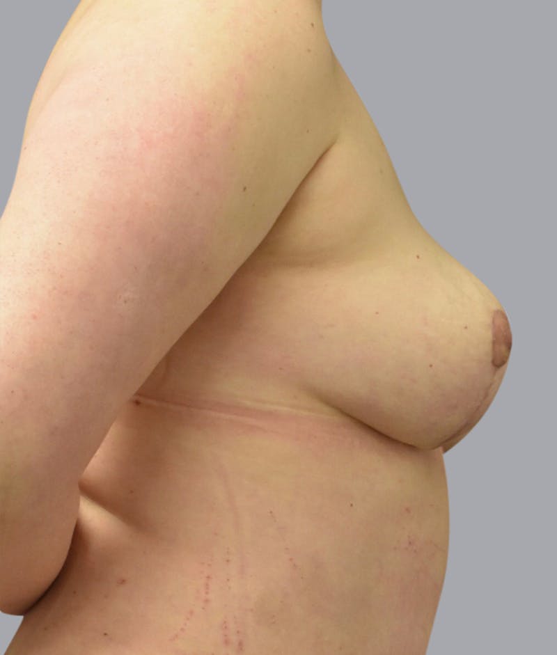 Breast Lift Before & After Gallery - Patient 55375364 - Image 4
