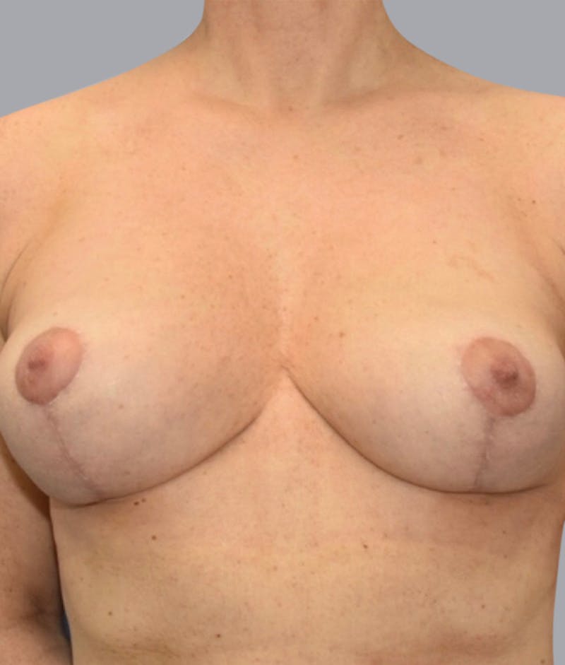 Breast Lift Before & After Gallery - Patient 55375376 - Image 2