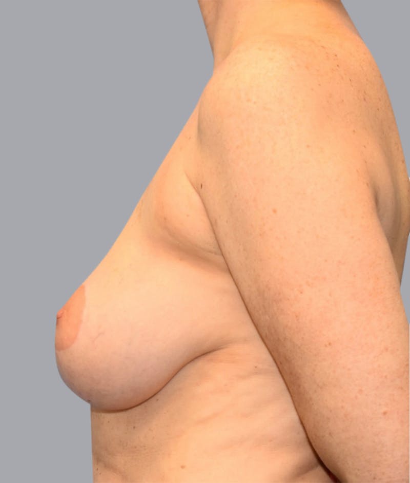 Breast Lift Before & After Gallery - Patient 55375376 - Image 5
