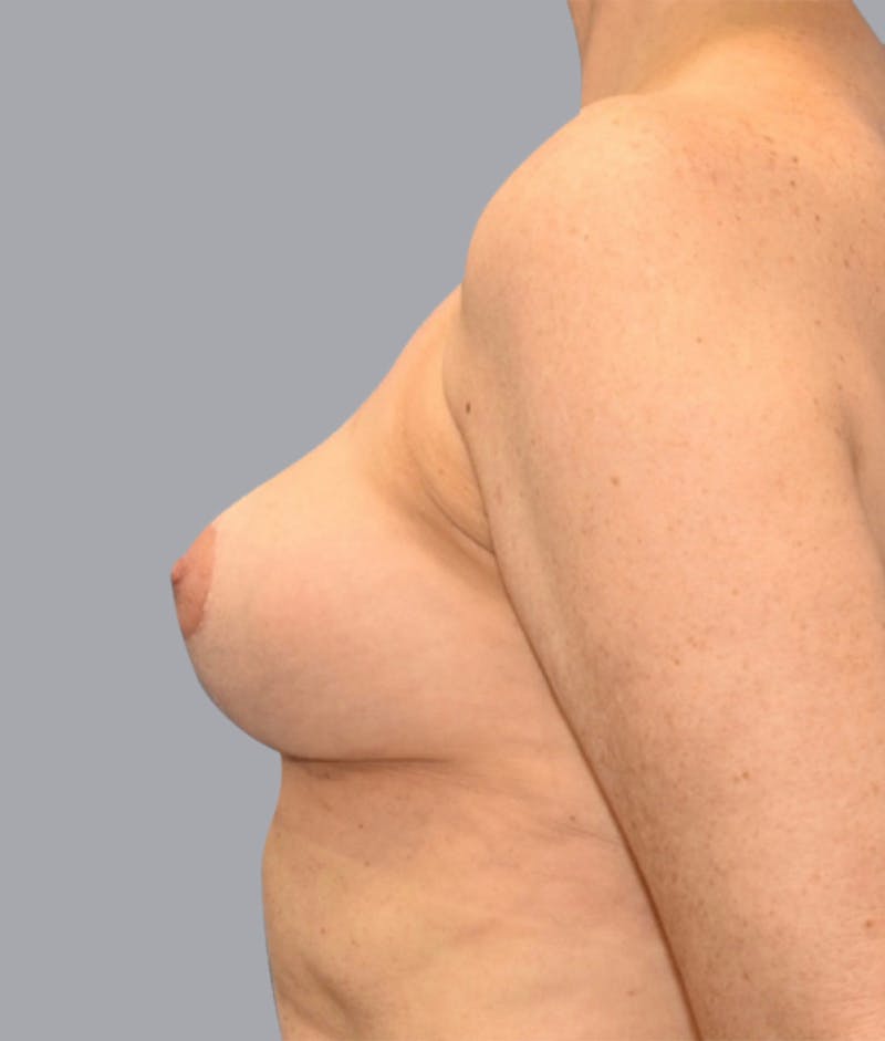 Breast Lift Gallery - Patient 55375376 - Image 6