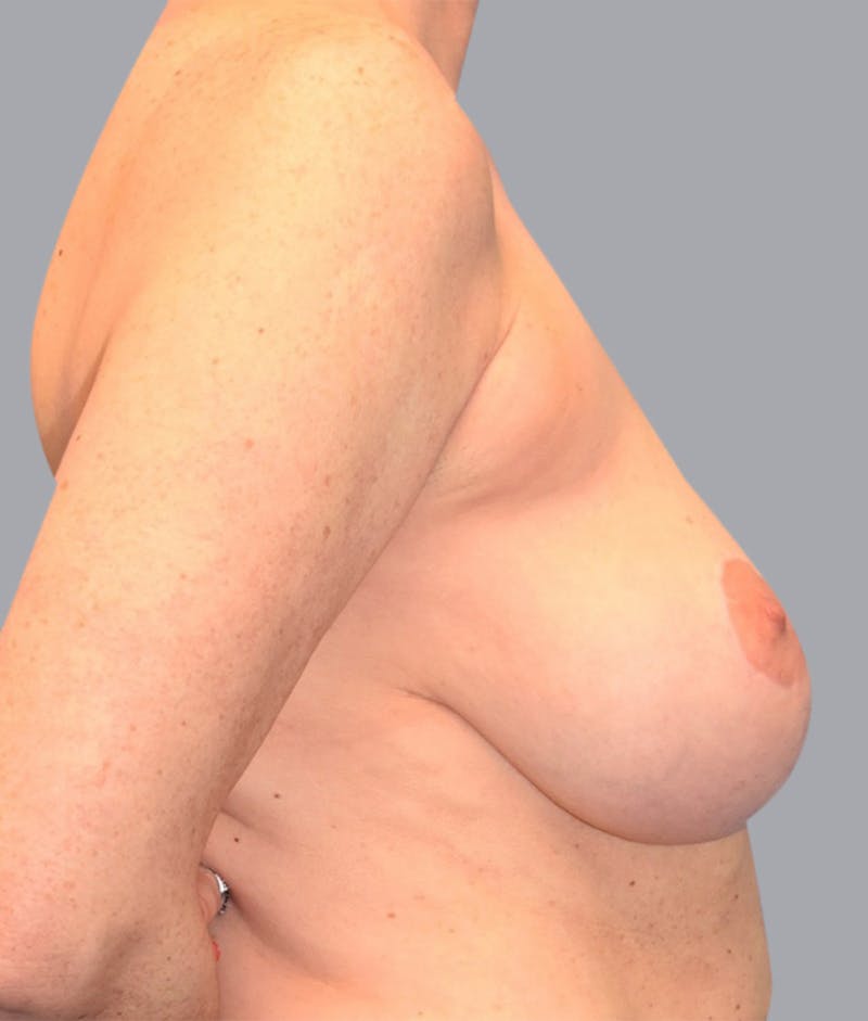 Breast Lift Before & After Gallery - Patient 55375376 - Image 3