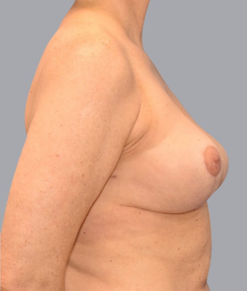Breast Lift Before & After Gallery - Patient 55375376 - Image 4