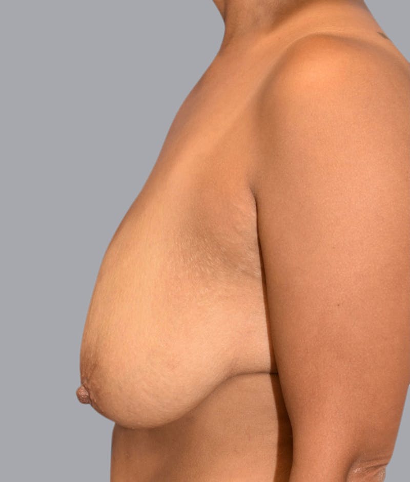Breast Lift Before & After Gallery - Patient 48704275 - Image 5