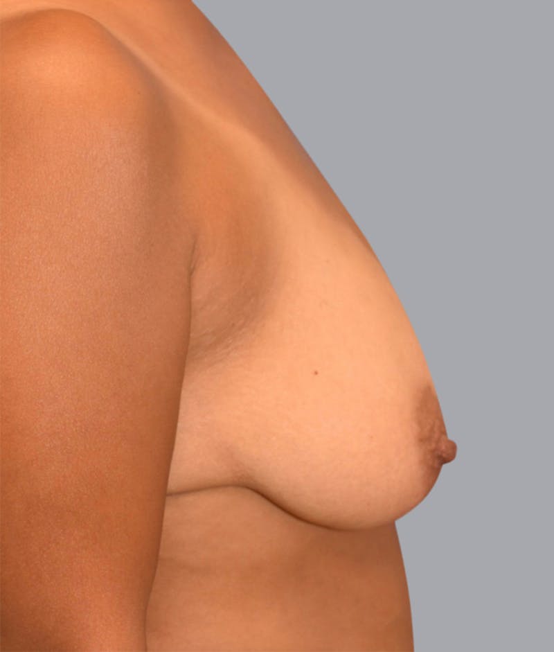 Breast Lift Gallery - Patient 48704275 - Image 3