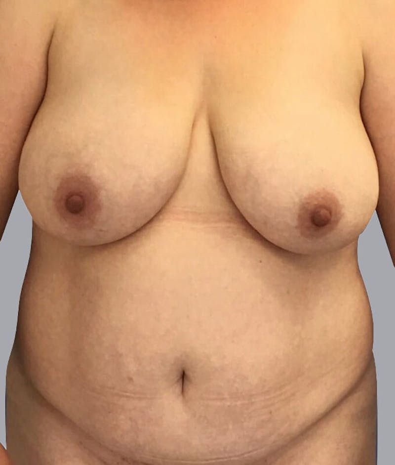 Breast Lift Before & After Gallery - Patient 48704274 - Image 1