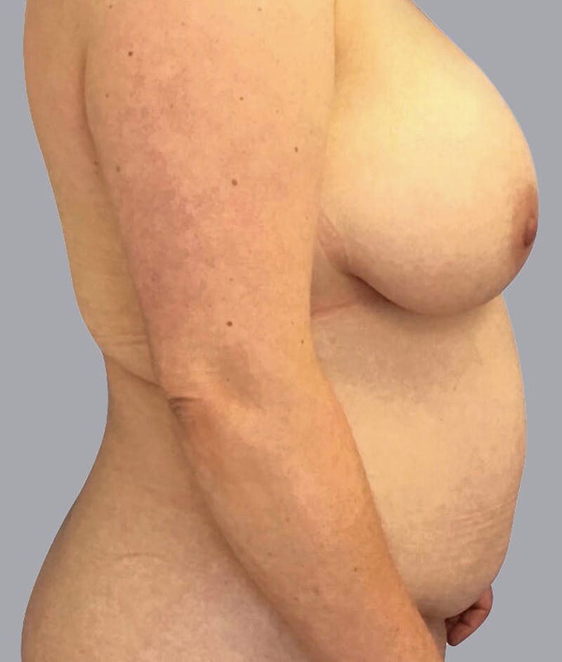 Breast Lift Before & After Gallery - Patient 48704274 - Image 3