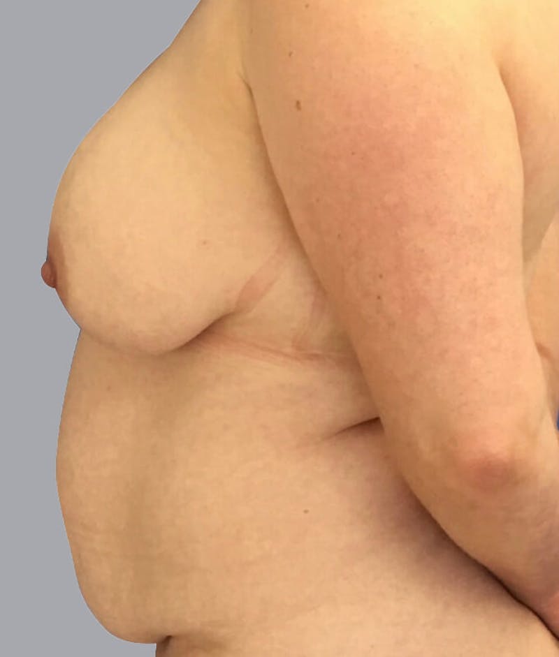 Breast Lift Before & After Gallery - Patient 48704274 - Image 5