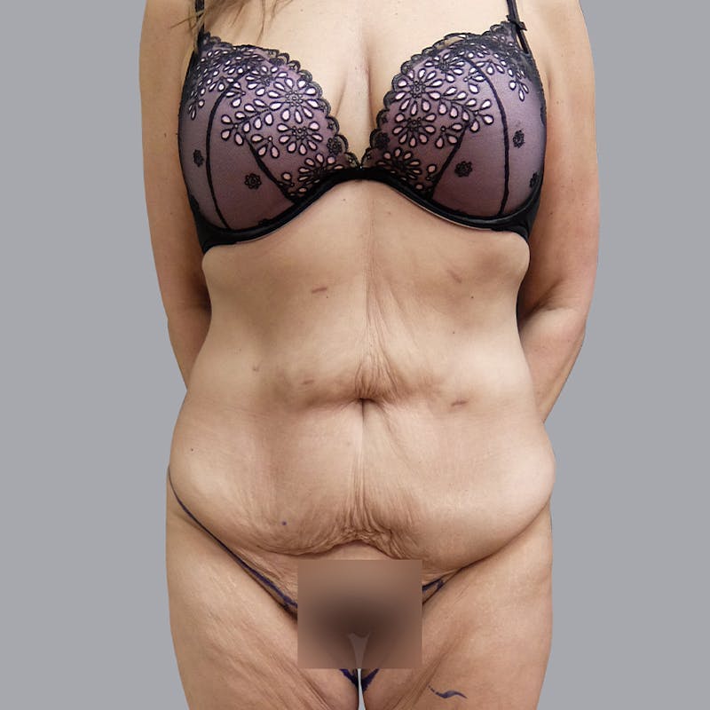 Abdominoplasty Before & After Gallery - Patient 55476646 - Image 1