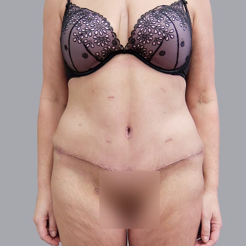 Abdominoplasty Before & After Gallery - Patient 55476646 - Image 2