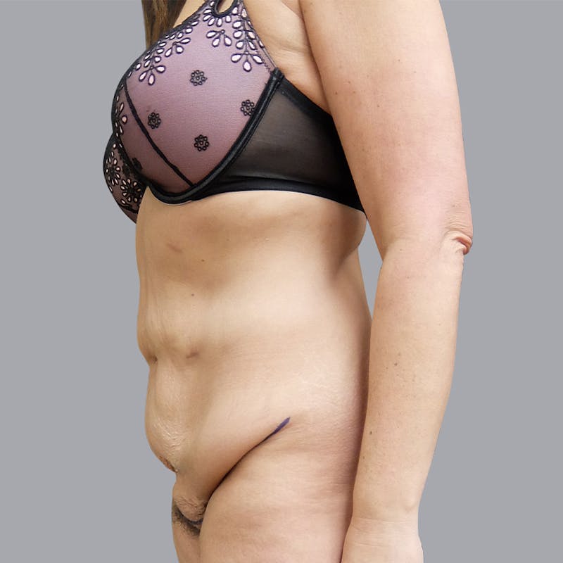 Abdominoplasty Before & After Gallery - Patient 55476646 - Image 3