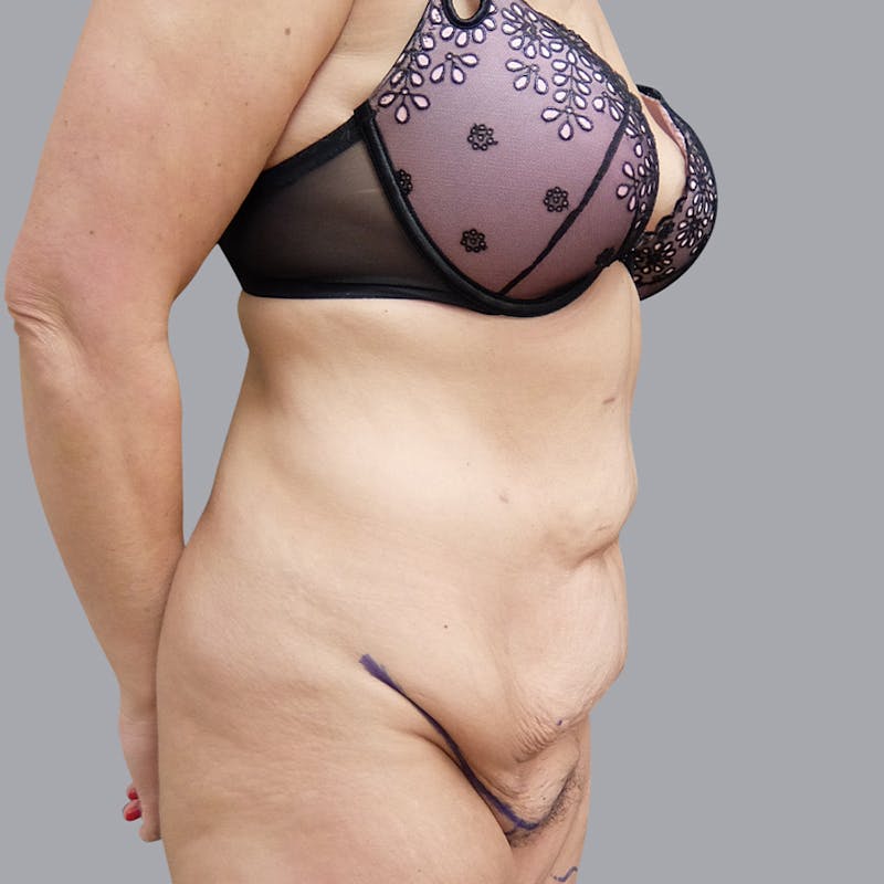 Abdominoplasty Before & After Gallery - Patient 55476646 - Image 5
