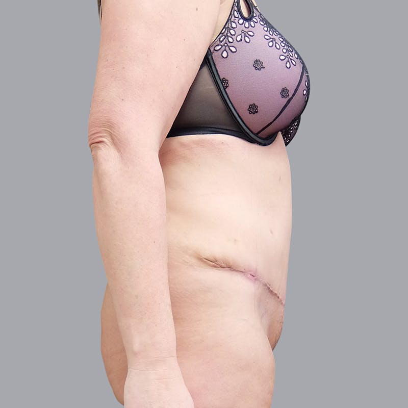 Abdominoplasty Before & After Gallery - Patient 55476646 - Image 6