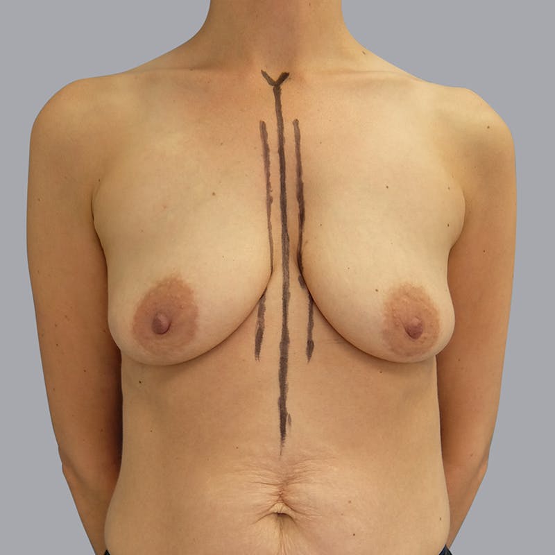 Breast Augmentation Gallery - Patient 55476658 - Image 1