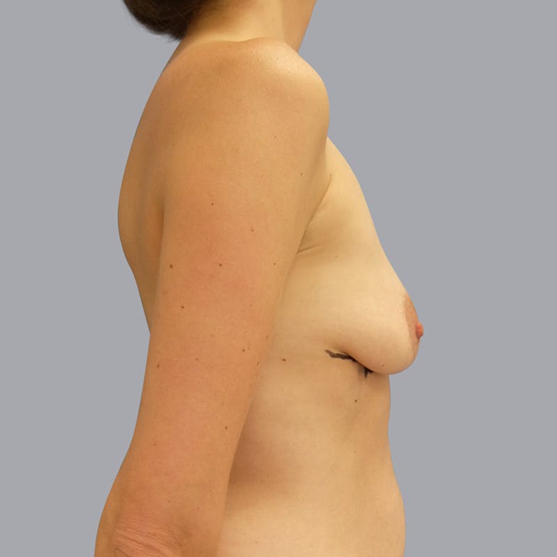 Breast Augmentation Before & After Gallery - Patient 55476658 - Image 3