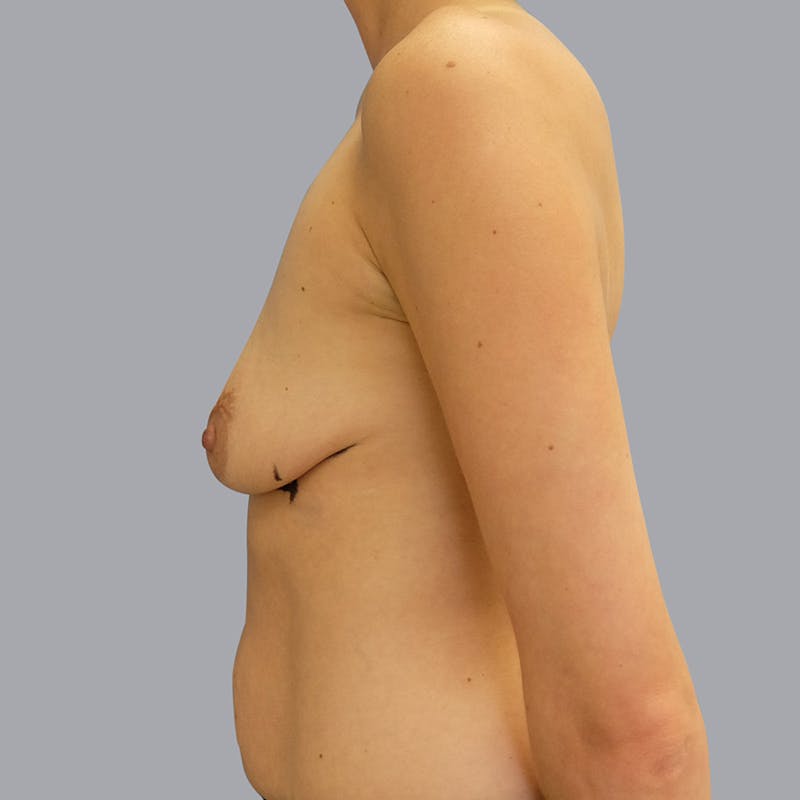 Breast Augmentation Before & After Gallery - Patient 55476658 - Image 5