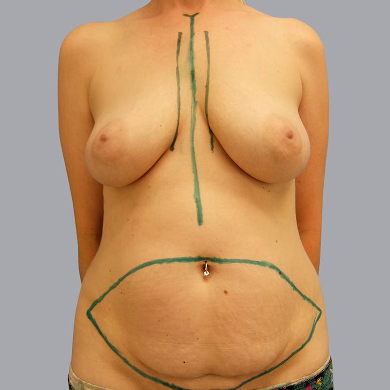 Mommy Makeover Before & After Gallery - Patient 55476664 - Image 1