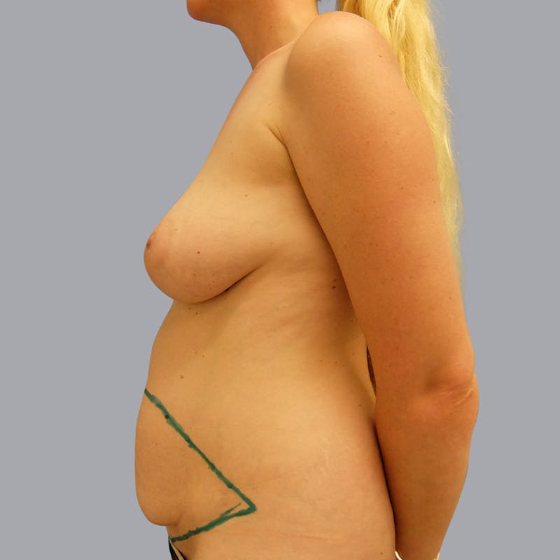 Mommy Makeover Before & After Gallery - Patient 55476664 - Image 3