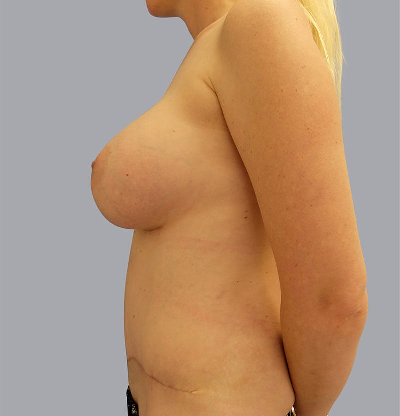 Mommy Makeover Gallery - Patient 55476664 - Image 4
