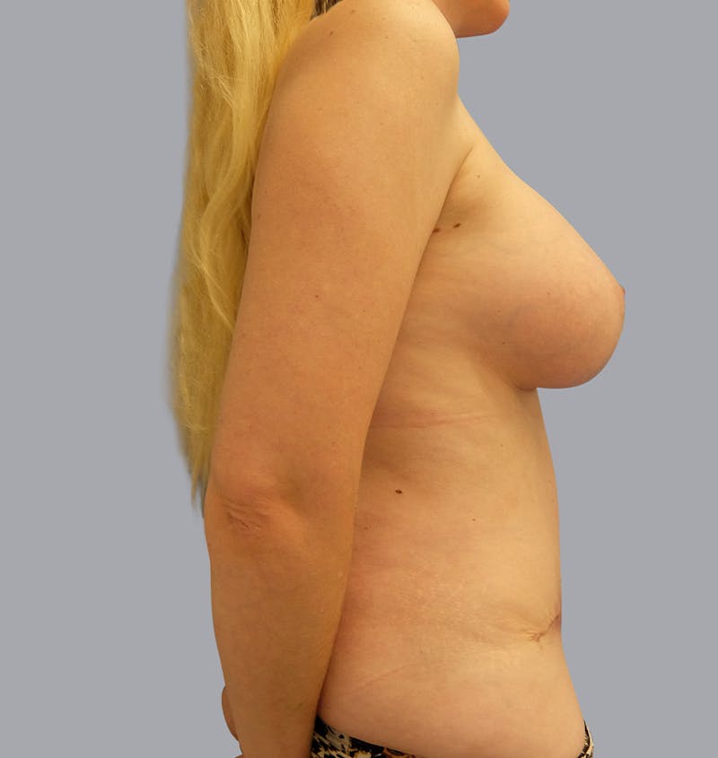 Mommy Makeover Before & After Gallery - Patient 55476664 - Image 6