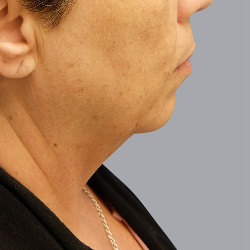 Facelift and Neck Lift Before & After Gallery - Patient 55476665 - Image 1