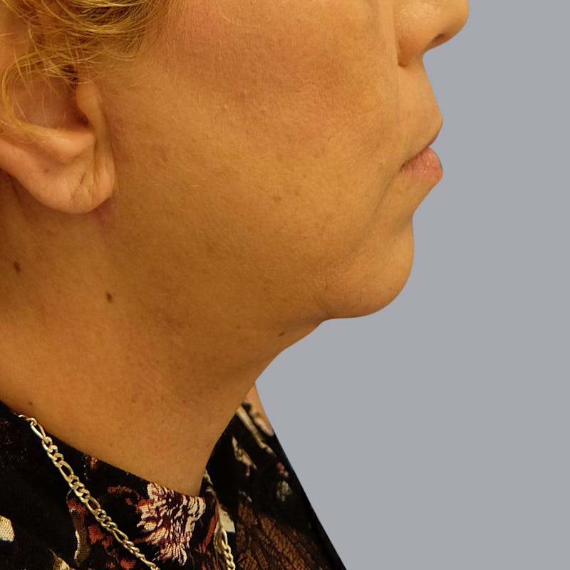 Neck Lift Before & After Gallery - Patient 55476665 - Image 2