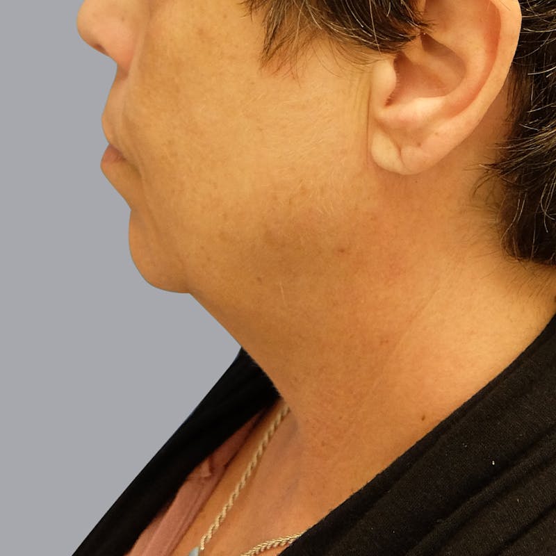 Facelift and Neck Lift Before & After Gallery - Patient 55476665 - Image 3