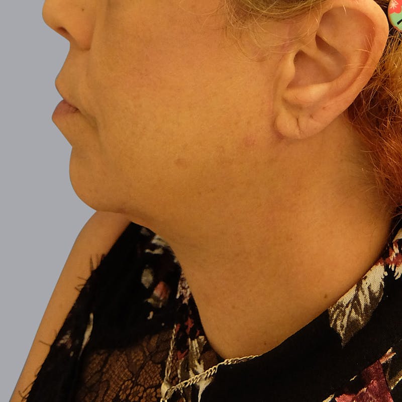Neck Lift Before & After Gallery - Patient 55476665 - Image 4