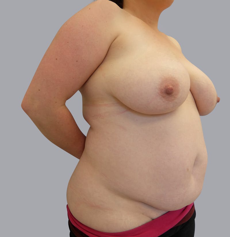 Mommy Makeover Before & After Gallery - Patient 55495969 - Image 3